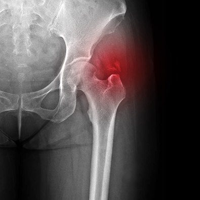 X-ray of hip bone with inflammation