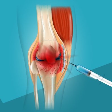 Animation of injection in knee