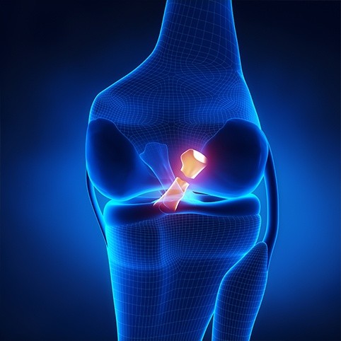 Animation of damaged knee