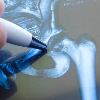 Pen pointing to x-ray of hip bones