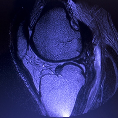 X-ray of damaged meniscus