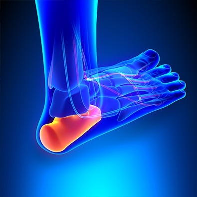 Animation of foot with plantar fasciitis