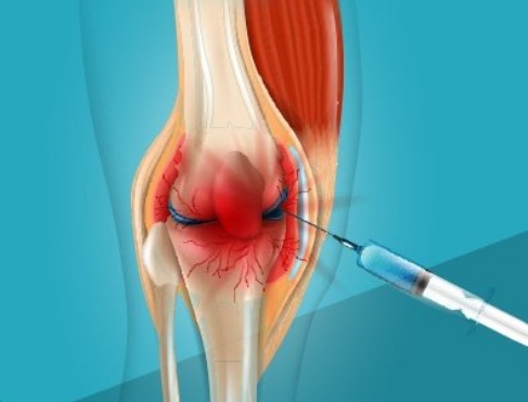 Animation of injection in knee