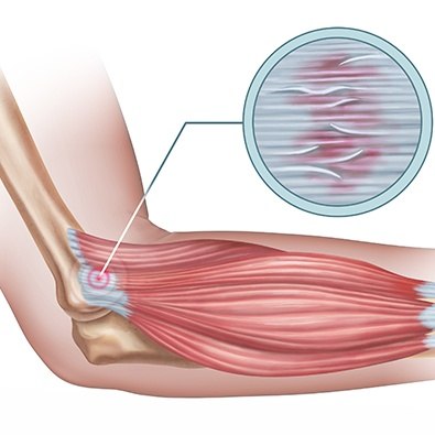 Animation of damaged elbow
