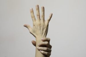 person with Carpal Tunnel Syndrome stretching fingers 
