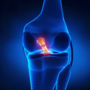graphic of a knee ligament injury 
